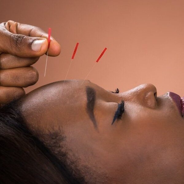 Experience the Power of Facial Acupuncture - The Natural Alternative to Botox