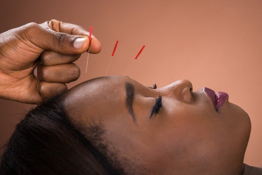 Experience the Power of Facial Acupuncture - The Natural Alternative to Botox